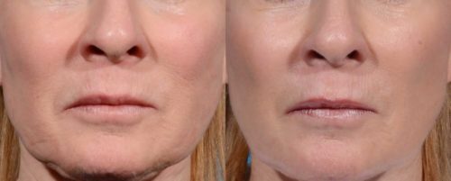 Morpheus 8 – A Revolution in Nonsurgical Face and Neck Lifts