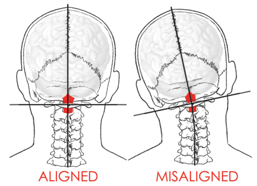 Does It Really Matter if My Upper Cervical Spine is Aligned?