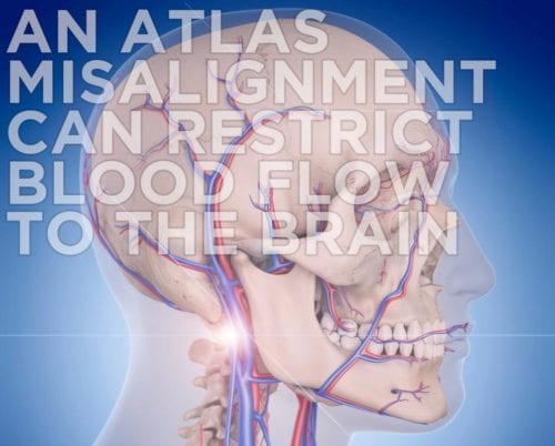An Atlas Misalignment Can Restrict Blood Flow to the Brain