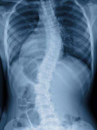 Upper Cervical Chiropractic Is Successful with Scoliosis Correction
