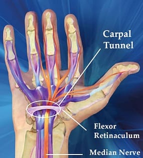 Atlanta, GA | Acupuncture and Carpal Tunnel Syndrome | Acupuncture for Pain