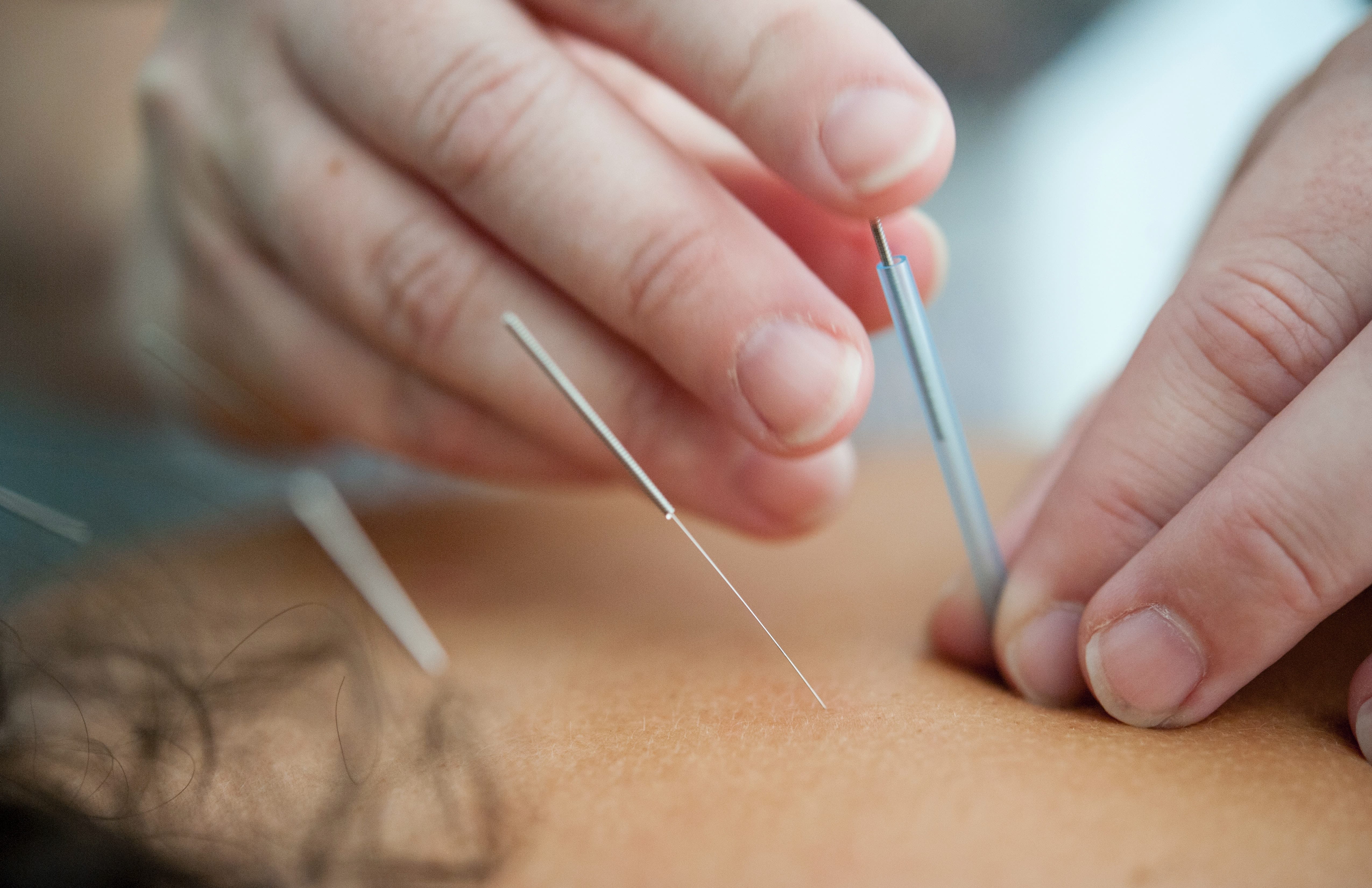 Atlanta, GA | Acupuncturist Fulton County | Acupuncture for Adults Fulton County