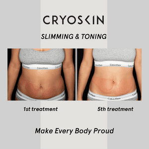 Atlanta, GA | Acupuncture for Weight Loss | Cryoskin Treatments now Offered