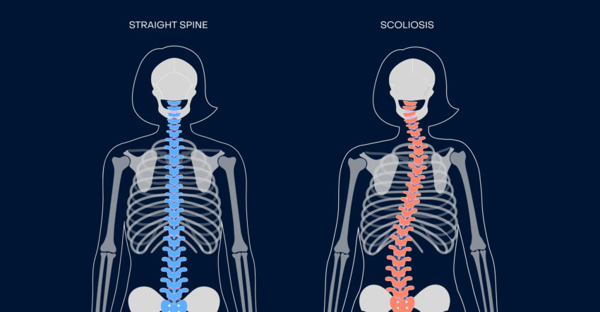 How Upper Cervical Chiropractic Helped My Patient Avoid Scoliosis Surgery