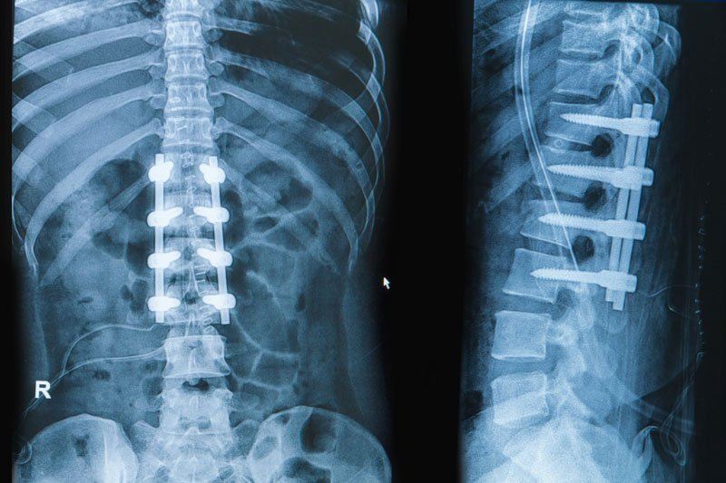 How Upper Cervical Chiropractic Helps Fusion Patients