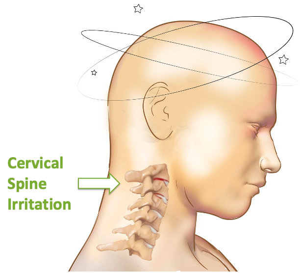 Cervical Vertigo: One of Many Manifestations of This Condition