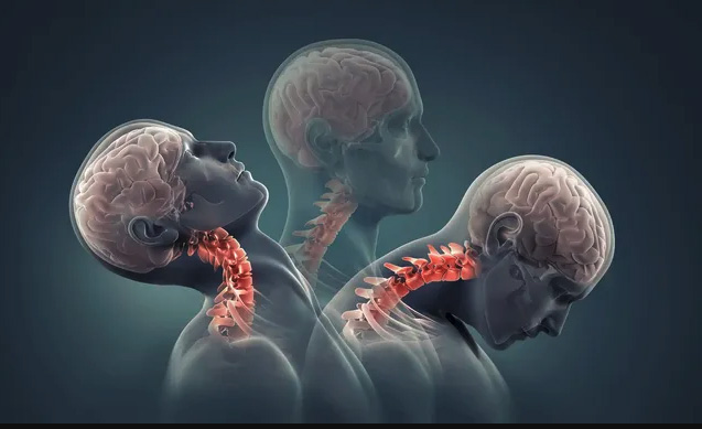 Fort Myers, FL - Navigating Upper Cervical Instability Through Chiropractic