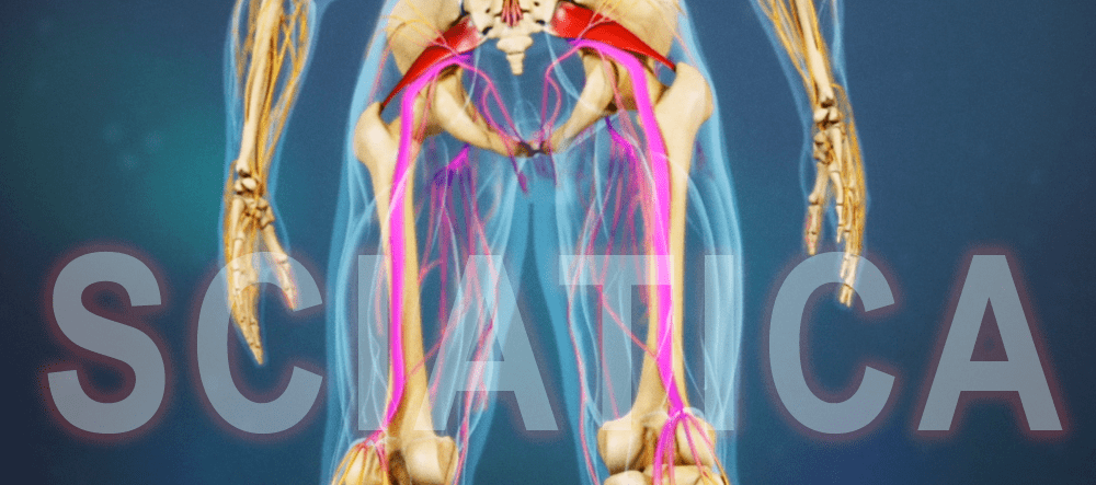 A Look Inside Sciatica