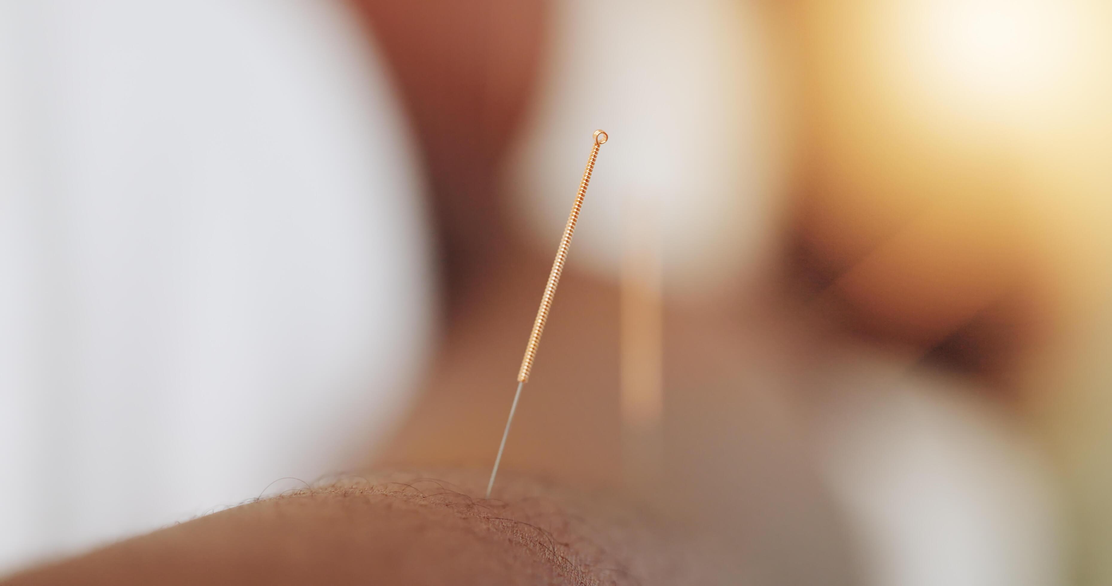 Lafayette, CA – Relieving Tension Headaches with Acupuncture and Cupping