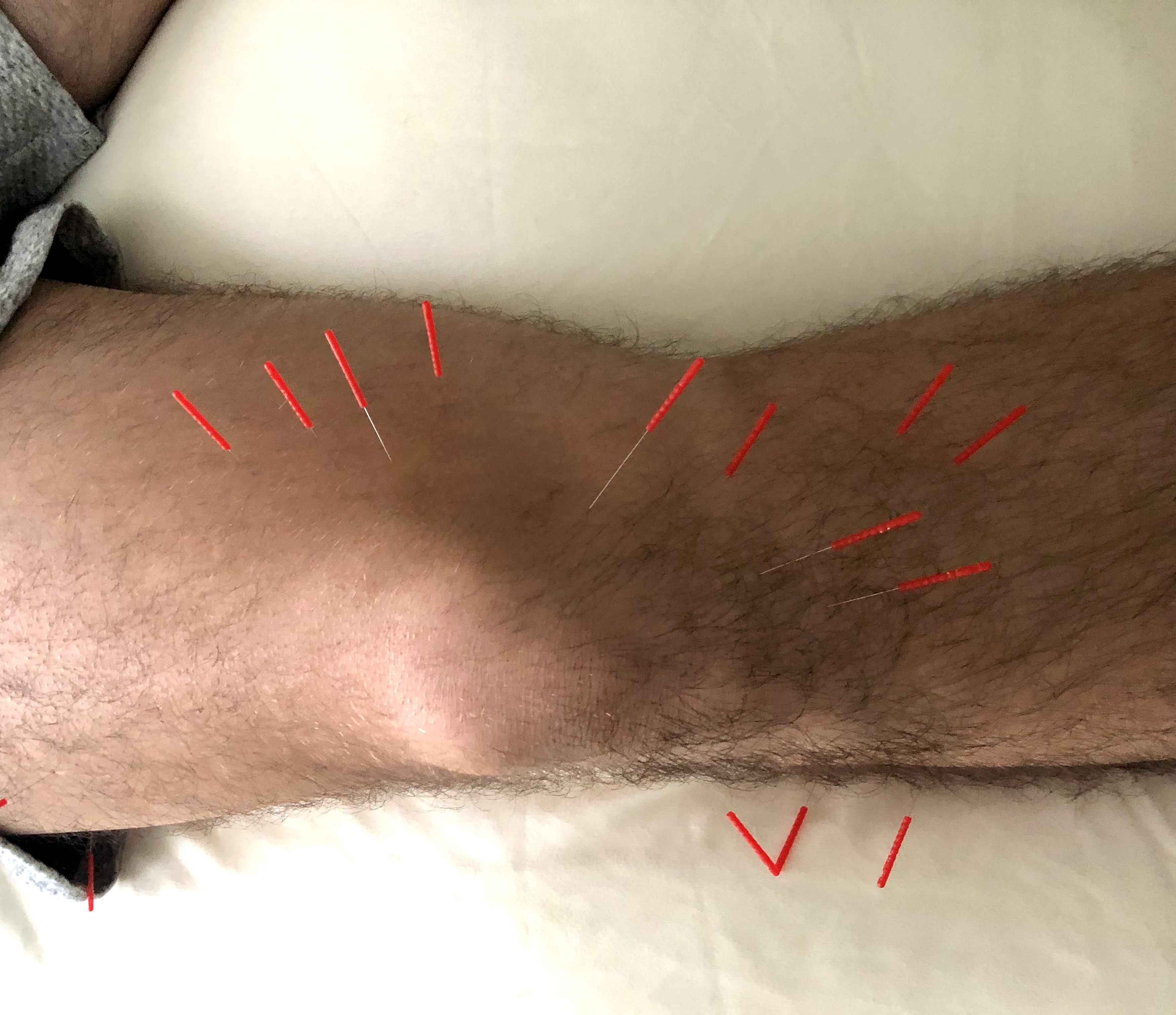 Oakland, CA - Healing Pediatric Tendinitis With Help from Acupuncture &amp; Gua Sha