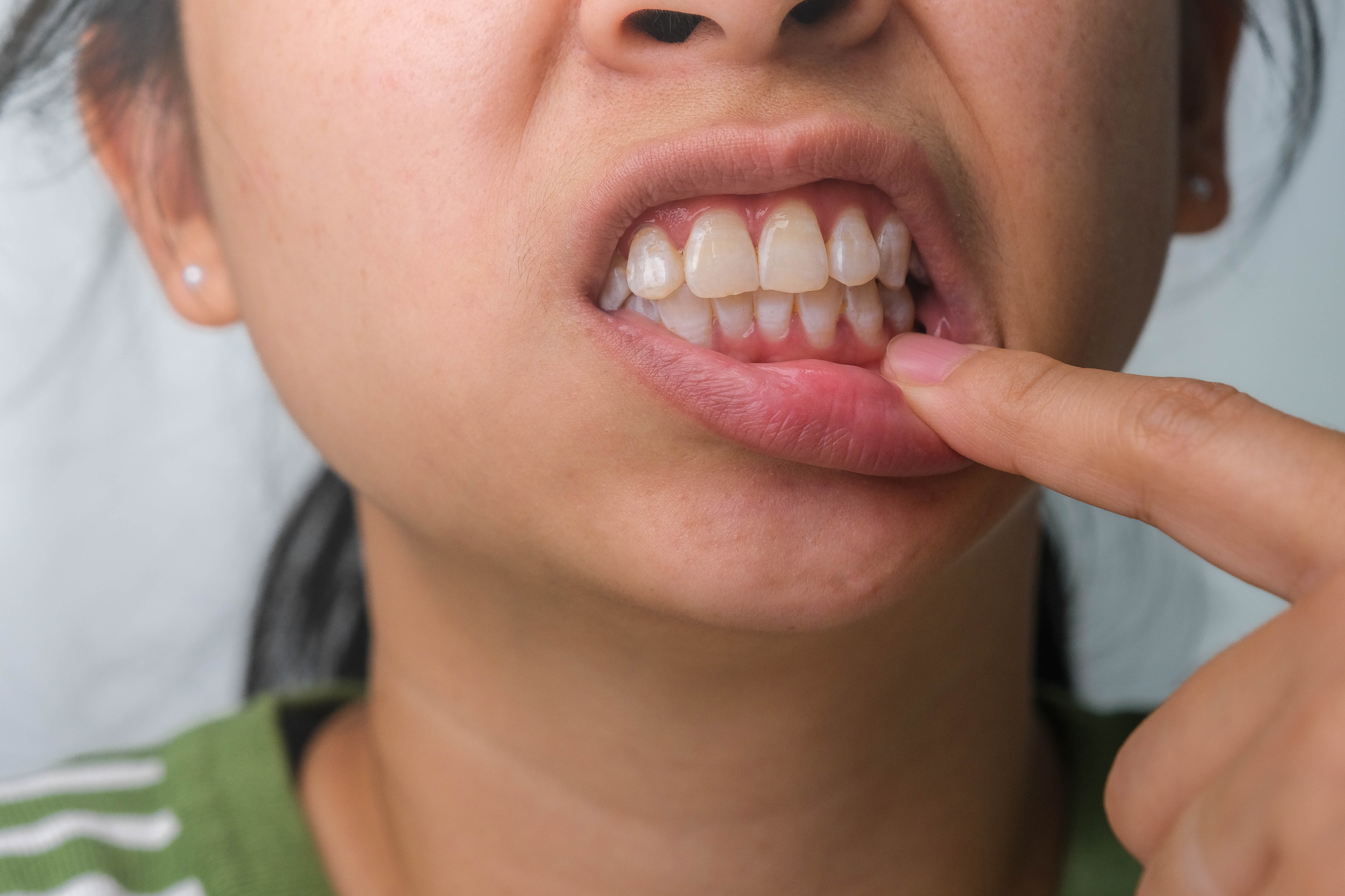 San Leandro, CA – How Mobile Dental Hygiene Care Helps Prevent Gum Disease