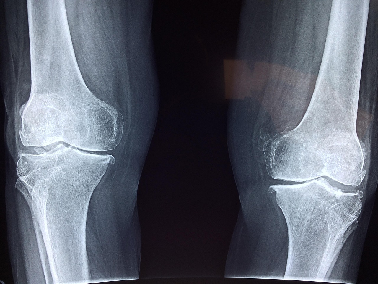 South Tucson, AZ - ACL Reconstruction Surgery Recovery for Injured Athletes